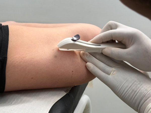 Prefeitura de Mairinque já realizou cerca de 300 inserções de Implanon em mulheres pela rede municipal de saúde em 2026