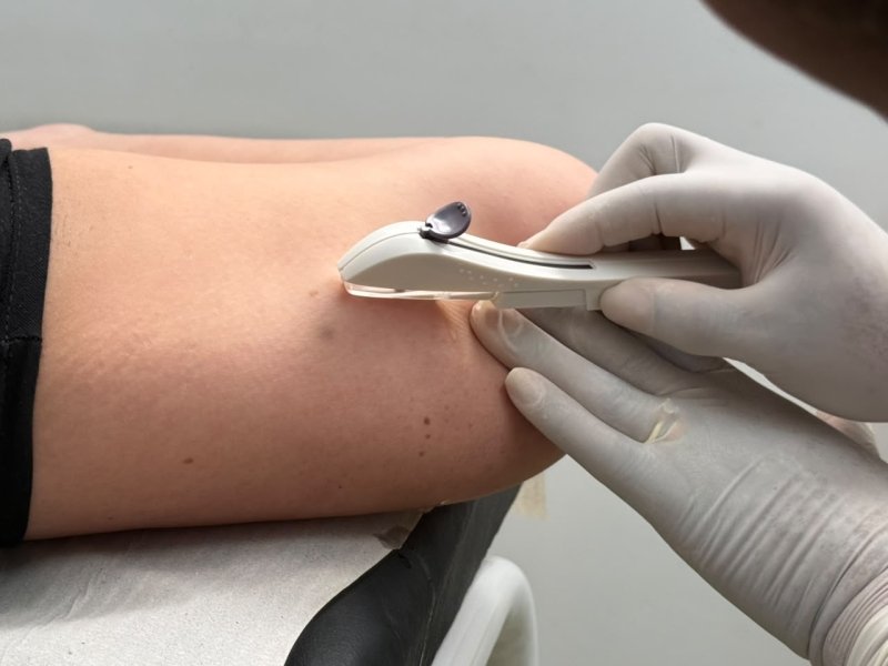 Prefeitura de Mairinque já realizou cerca de 300 inserções de Implanon em mulheres pela rede municipal de saúde em 2026